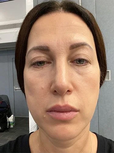 Patient before Botox treatment