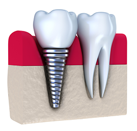 Illustration of a dental implant post and crown beside natural teeth