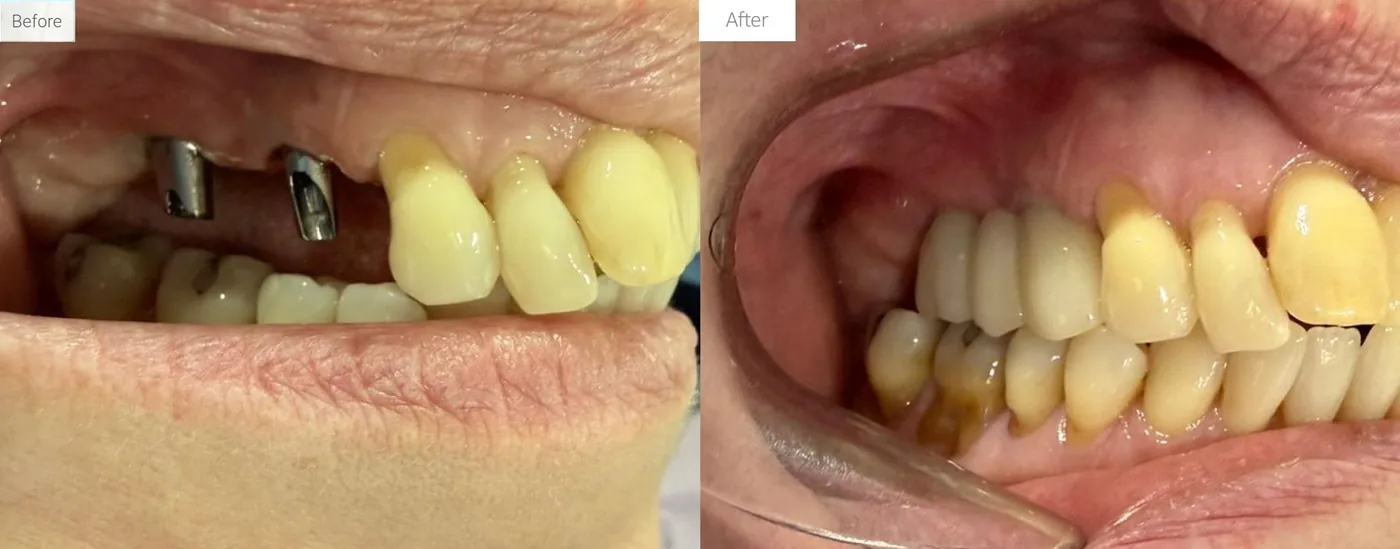 Dental implants before and after: missing teeth replaced