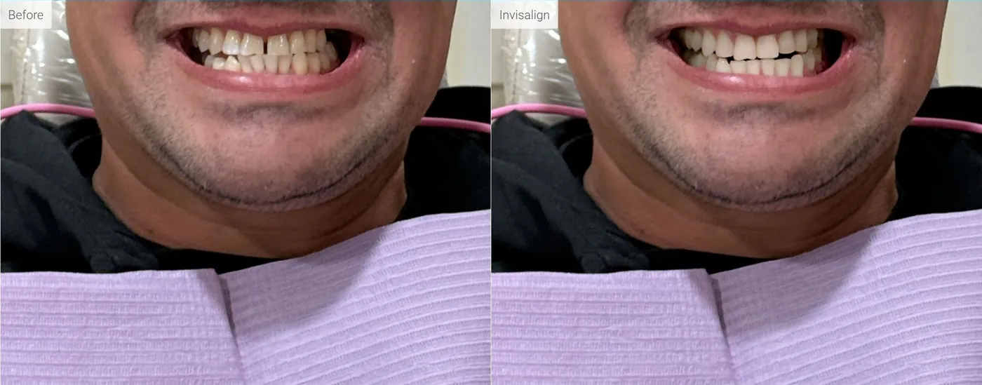 Before and after photos of a smile straightened with Invisalign