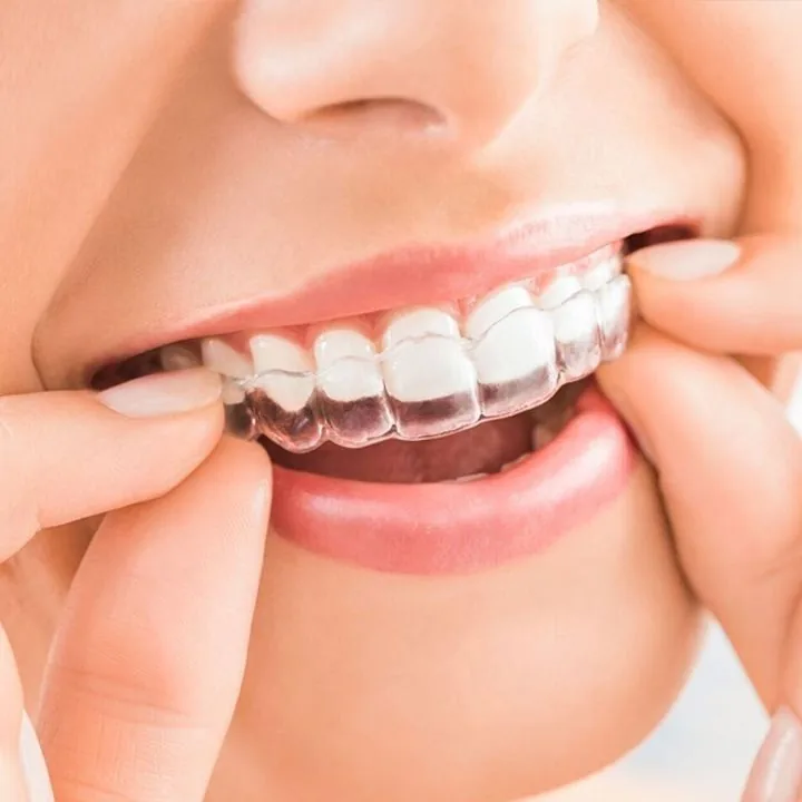 A clear Invisalign aligner being placed over the teeth
