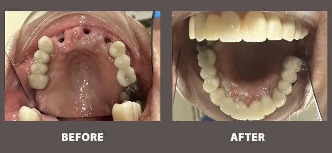Smile gallery case 1: before and after treatment