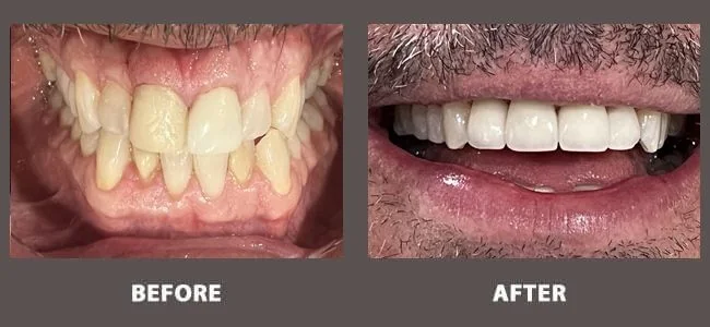 Smile gallery case 2: before and after treatment