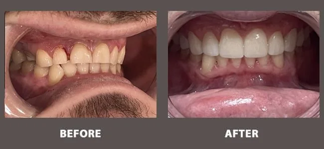 Smile gallery case 3: before and after treatment