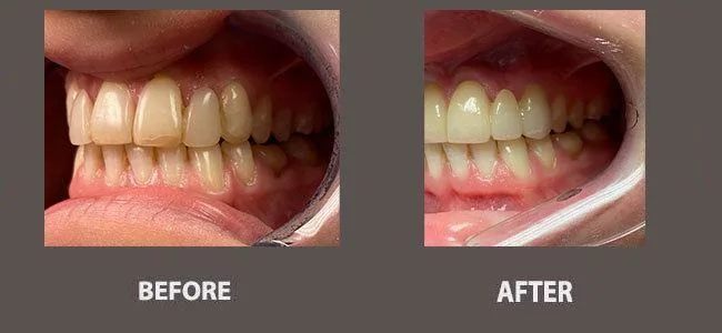 Smile gallery case 4: before and after treatment
