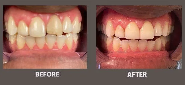 Smile gallery case 5: before and after treatment
