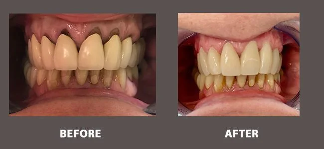 Smile gallery case 6: before and after treatment
