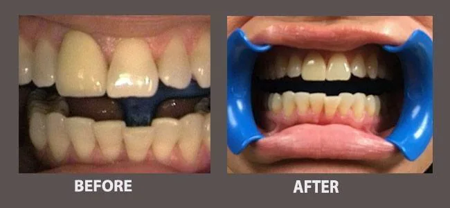 Smile gallery case 7: before and after treatment