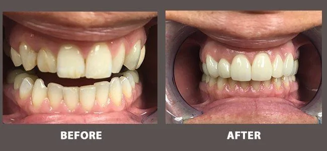 Smile gallery case 8: before and after treatment