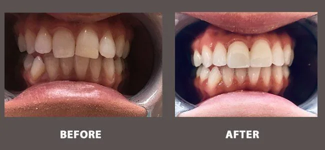 Smile gallery case 9: before and after treatment