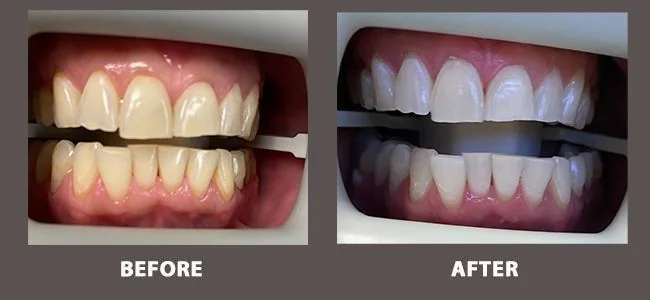 Smile gallery case 10: before and after treatment