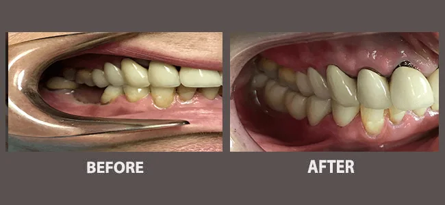 Smile gallery case 11: before and after treatment