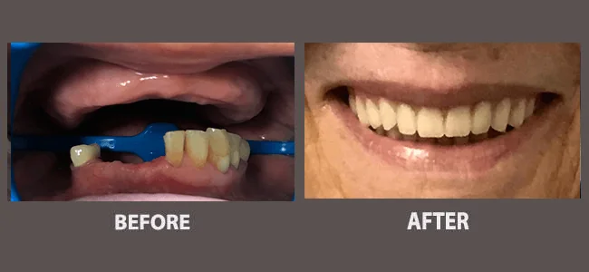 Smile gallery case 12: before and after treatment
