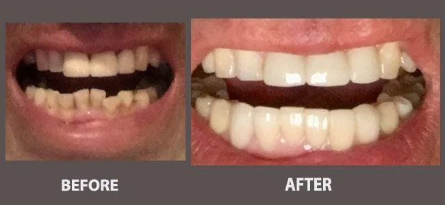 Smile gallery case 13: before and after treatment