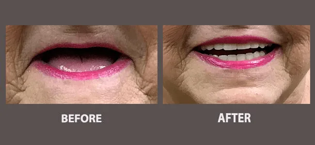 Smile gallery case 14: before and after treatment