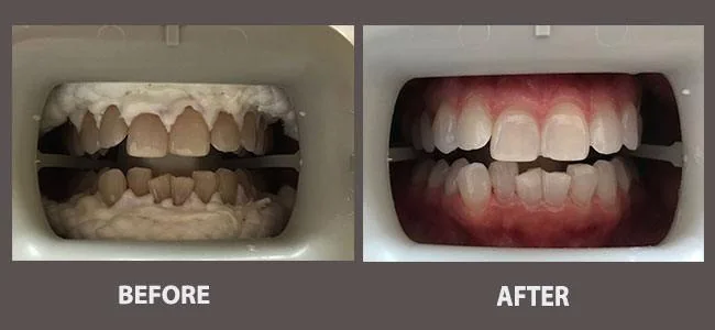 Smile gallery case 15: before and after treatment