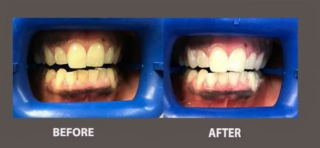 Smile gallery case 16: before and after treatment