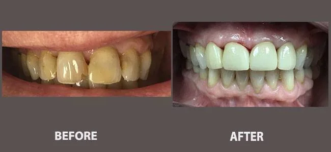 Smile gallery case 17: before and after treatment