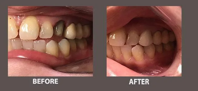 Smile gallery case 18: before and after treatment