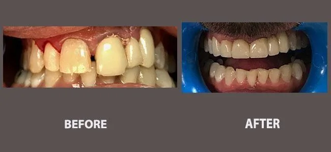 Smile gallery case 19: before and after treatment
