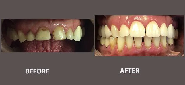 Smile gallery case 20: before and after treatment