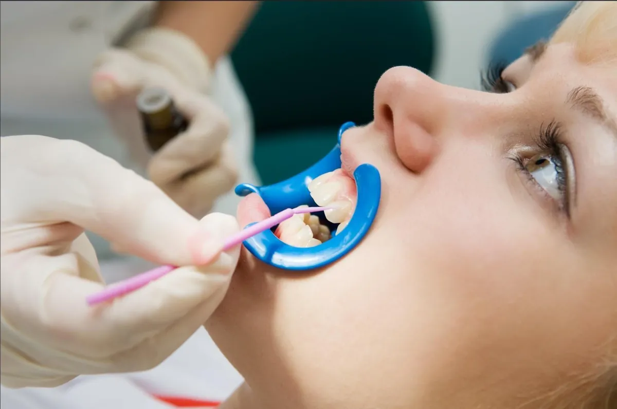 A patient having a professional whitening gel applied to her teeth